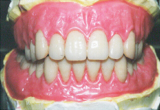精密義歯前図