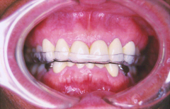 歯ぎしり・顎関節症